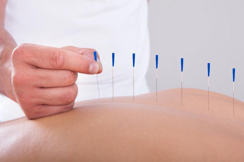 کاهش استرس با طب سوزنی