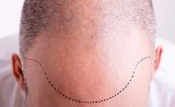 جراحی کاشت مو HairTransplant