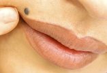 خال بالای لبها PRinc_photo_of_benign_nevus_above_lip