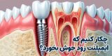 زود جوش خوردن ایمپلنت دندان