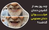 چند روز بعد از کشیدن دندان میتــــــــــــــــــوان دندان مصنوعی گذاشت؟