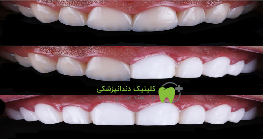 مراقبت بعد از کامپوزیت دندان