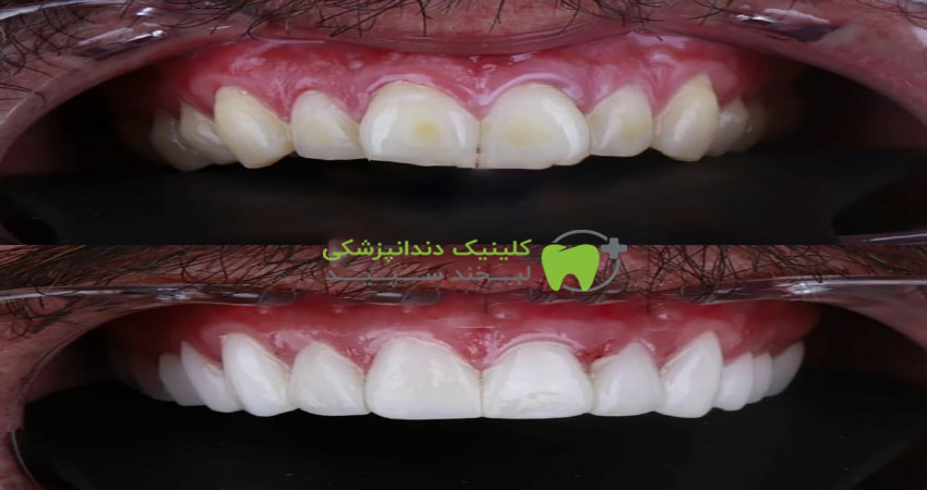 ماندگاری کامپوزیت دندان