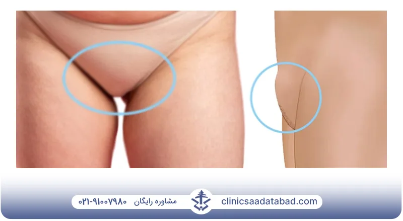 تصاویر تزریق چربی به واژن
