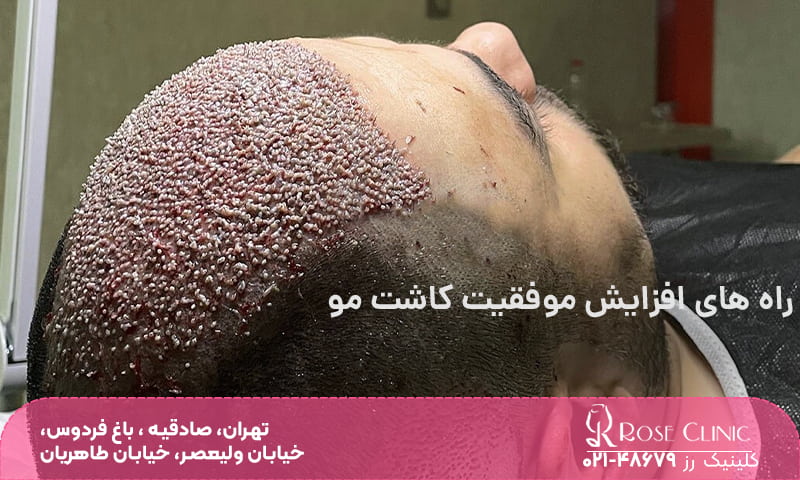 فردی که خوابیده و قسمت پیشانی و روی سرش مو کاشته است