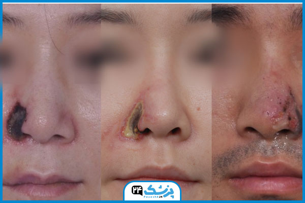 نکروز بینی بعد از انزیم زدن