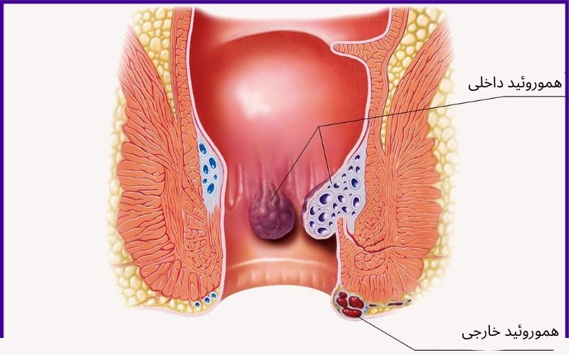 بواسیر چیست و چه علائمی دارد؟