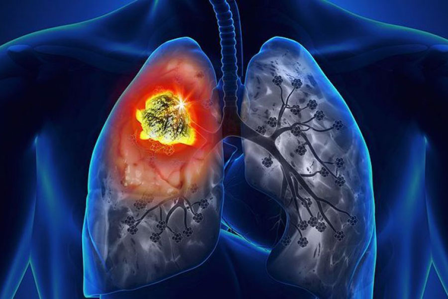 عفونت شدید ریه در سالمندان