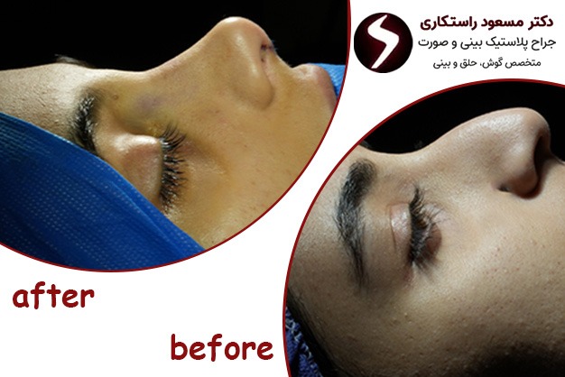 رضایت مراجعه کننده از نتیجه عمل بینی دکتر راستکاری