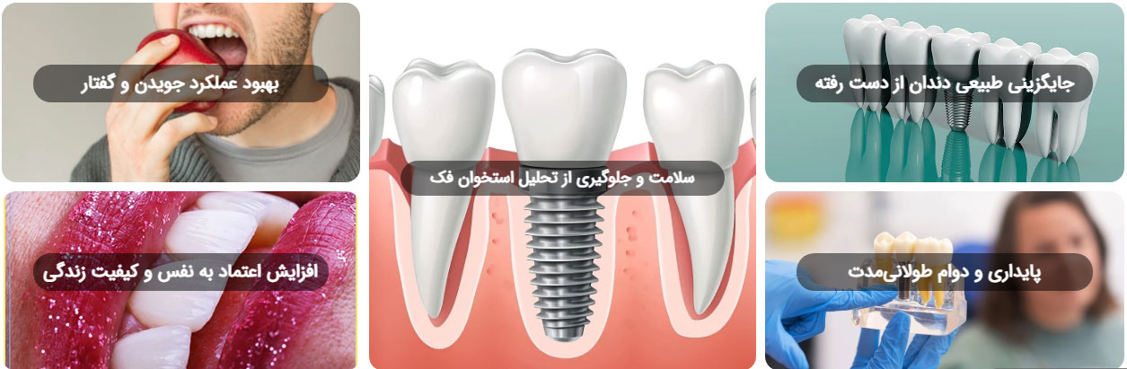 تجربه متفاوت کاشت دندان با ایمپلنت دیجیتال