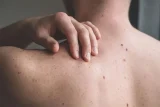 مشکلات رایج پوست