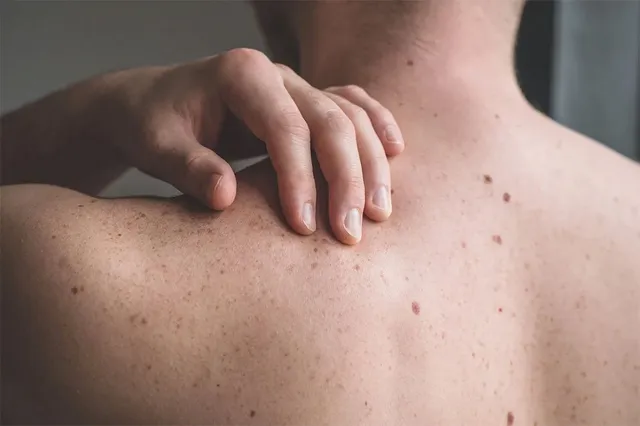 مشکلات رایج پوست