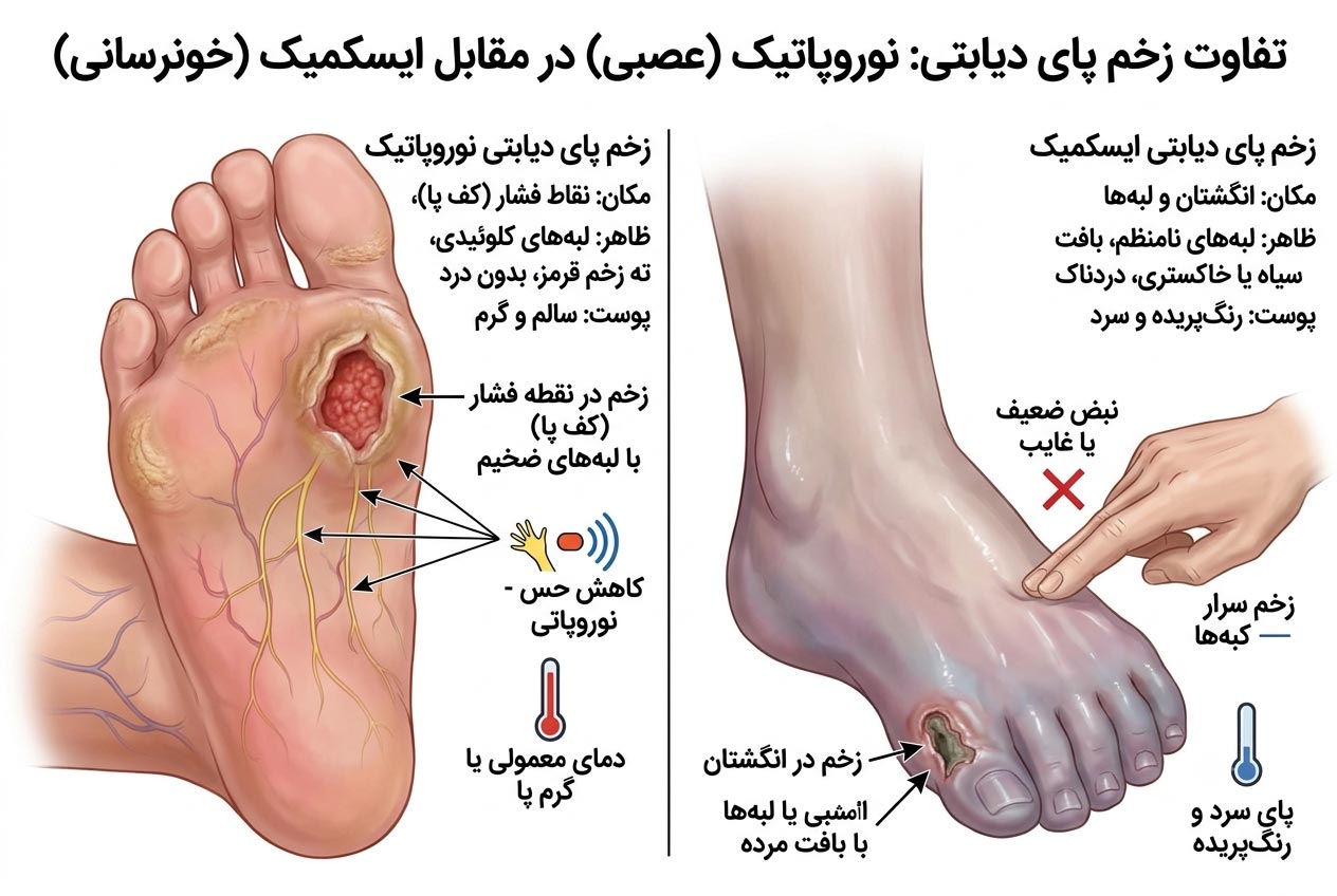 تفاوت زخم پای دیابتی نوروپاتیک و ایسکمیک