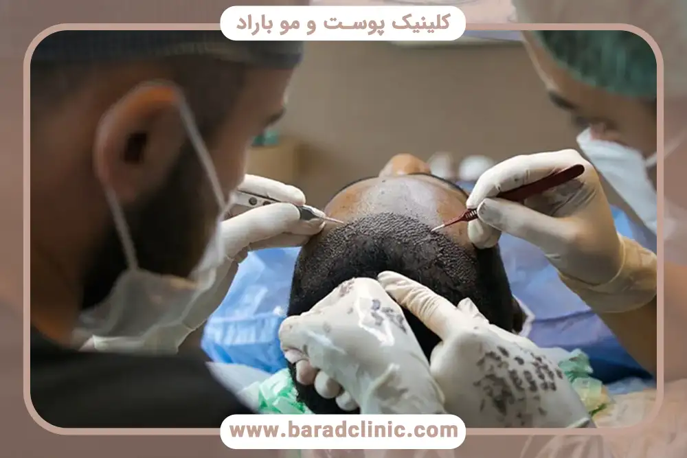 هزینه کاشت مو در ایران چقدر است؟