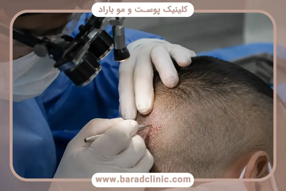 مراقبت‌های بعد از کاشت مو