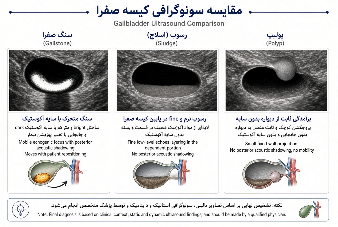 مقایسه انواع نتایج سونوگرافی کیسه صفرا